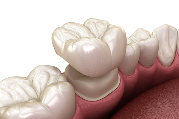 What Can Dental Crowns Do for Your Oral Health Issues? from Brilliant Smiles Lakeland in Lakeland, FL