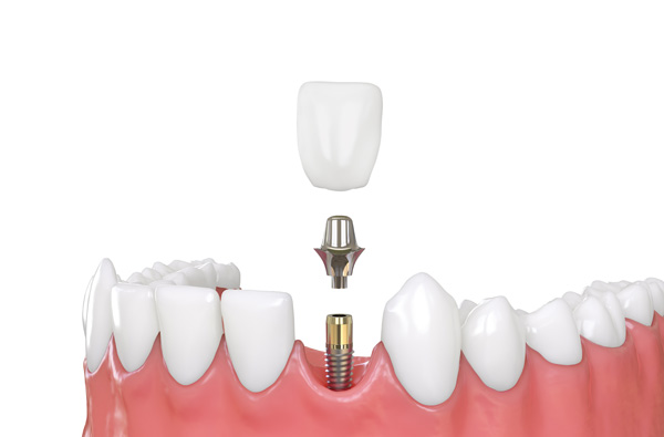 Do Dental Implants Look And Feel Natural?