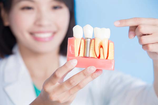 Why Dental Implants Are Good For Your Health