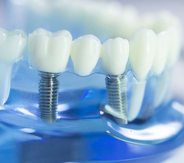 Lakeland Dental Implants