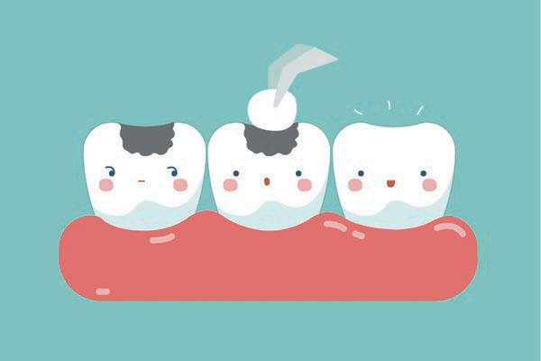 The FAQs Of Composite Fillings